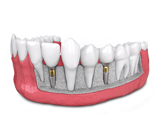 bone graft model