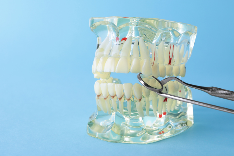 Image of a full mouth dental implant with clear jaw prosthesis